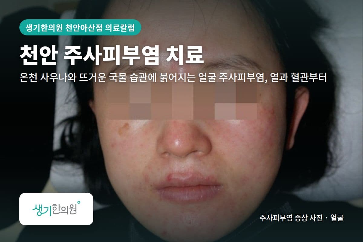 얼굴 주사피부염 증상 사진과 문구 「천안 주사피부염 치료, 온천 사우나와 뜨거운 국물 습관에 붉어지는 얼굴 주사피부염, 열과 혈관부터 · 생기한의원 천안아산점」