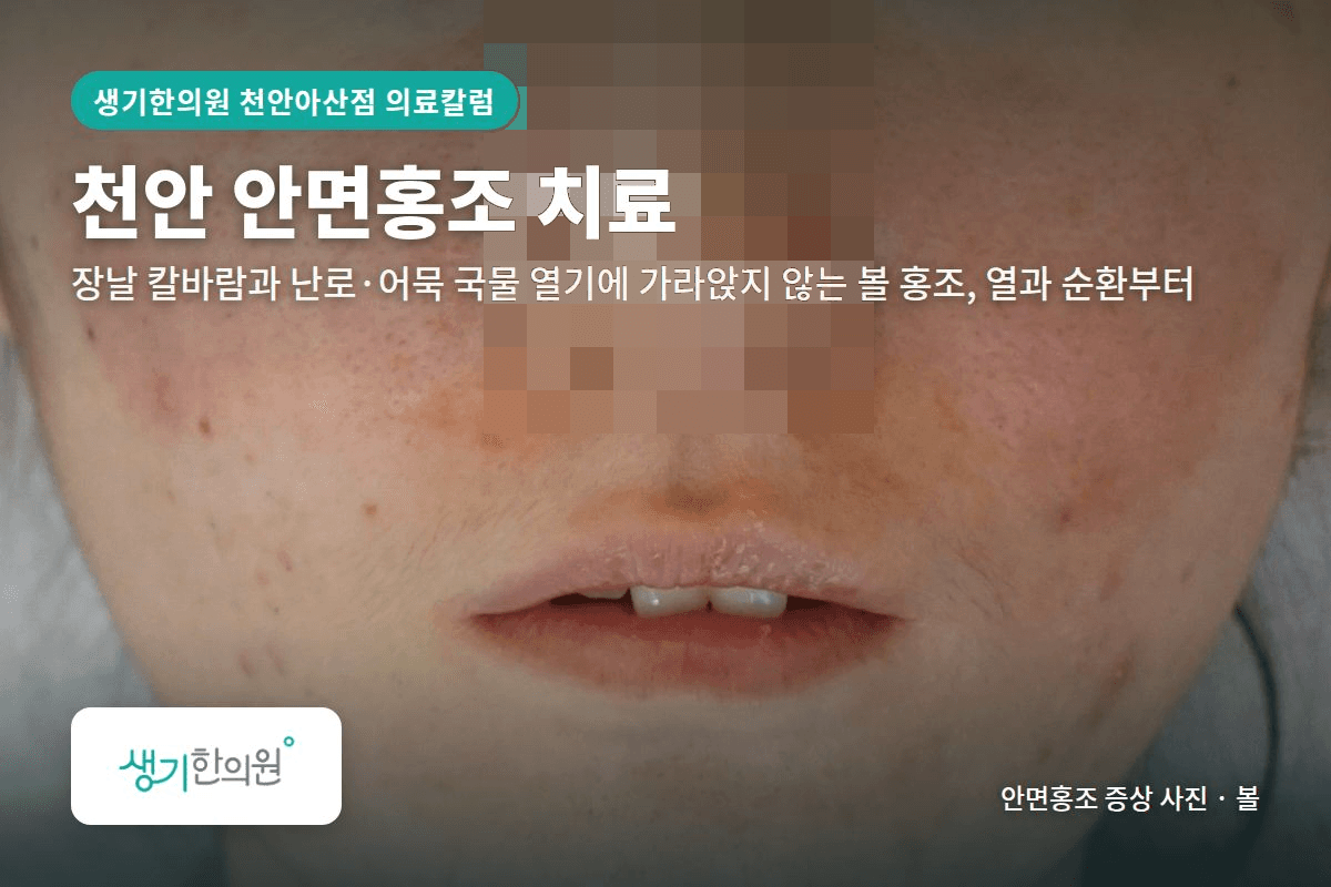 볼 안면홍조 증상 사진과 문구 「천안 안면홍조 치료, 장날 칼바람과 난로·어묵 국물 열기에 가라앉지 않는 볼 홍조, 열과 순환부터 · 생기한의원 천안아산점」