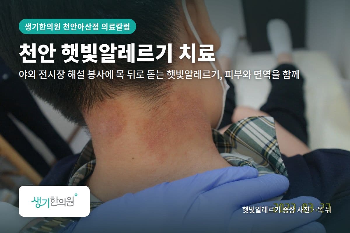 목 뒤 햇빛알레르기 증상 사진과 문구 「천안 햇빛알레르기 치료, 야외 전시장 해설 봉사에 목 뒤로 돋는 햇빛알레르기, 피부와 면역을 함께 · 생기한의원 천안아산점」